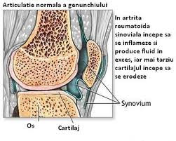 Artroza de gradul 1 a recenziilor tratamentului genunchiului unguentul pentru articulații este lung