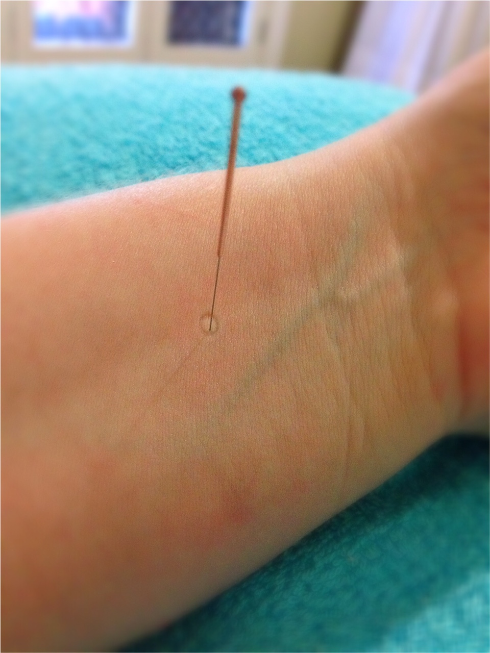 Chinese Medicine World The difference between acupuncture and