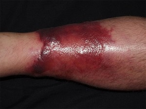 enfermedad celulitis bacteriana enfermedad celulitis bacteriana