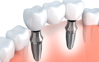 Cấu tạo của răng implant như thế nào?