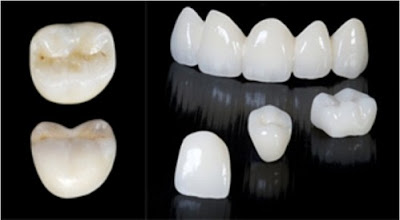 Top 3 vấn đề bạn cần biết trước khi bọc răng sứ Luu-y-truoc-khi-boc-rang-su