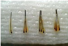 La realidad de los implantes capilares en España La realidad de los implantes capilares en España