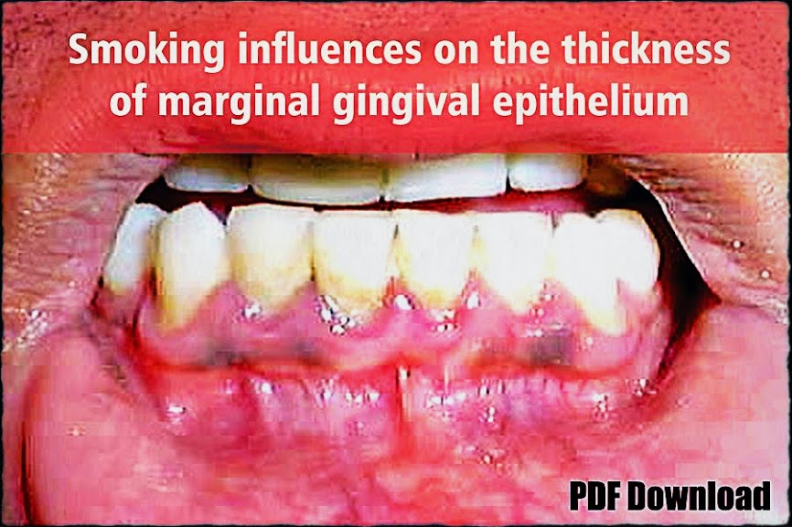 PDF Smoking influences on the thickness of marginal gingival