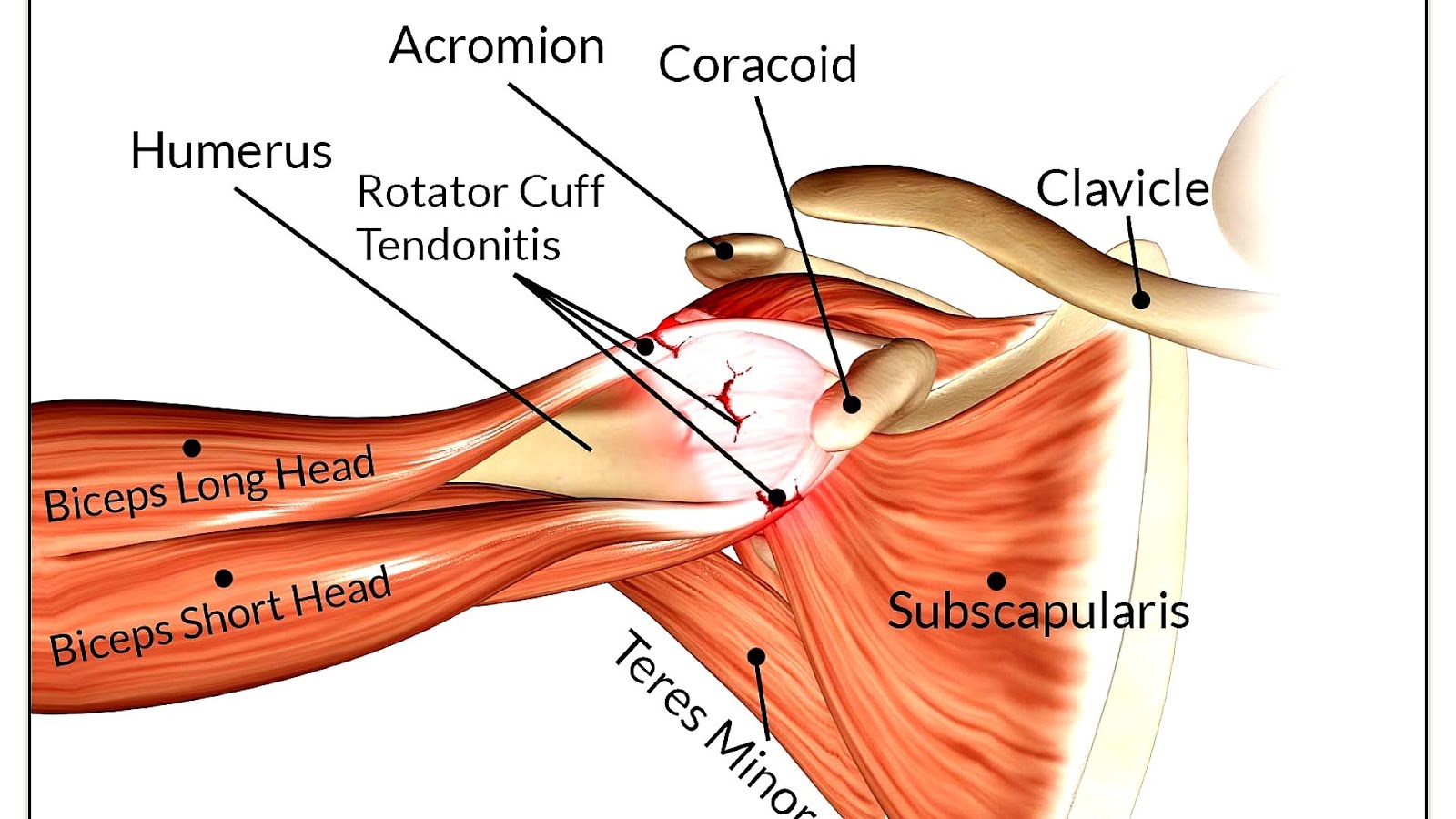 Rotary Cuff Injury Symptoms Injury Choices
