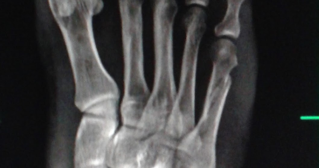 DICAS DE RADIOLOGIA IMAGENS RADIOLÓGICAS FRATURA OBLIQUA DO QUINTO METATARSO DICAS DE RADIOLOGIA IMAGENS RADIOLÓGICAS FRATURA OBLIQUA DO QUINTO METATARSO