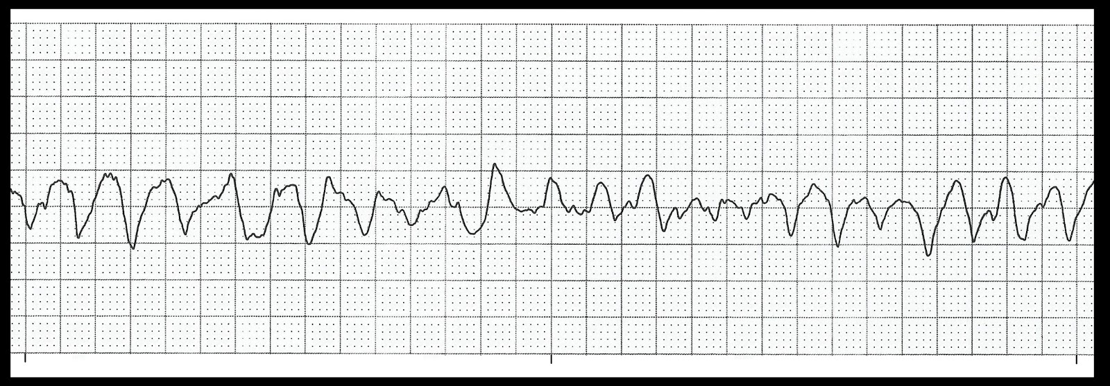 Basic EKG Rhythm Test 07