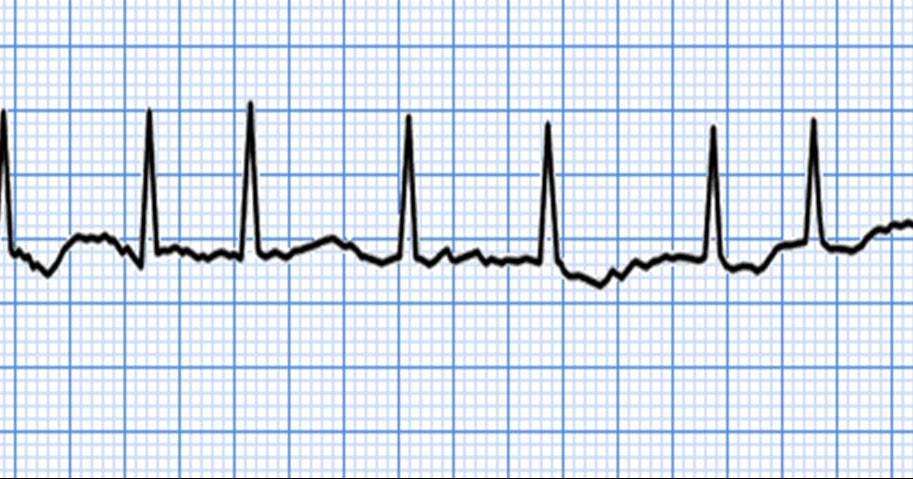 аритмия после еды