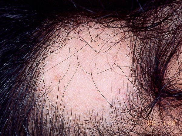 manchas blancas sin pelo en la cabeza