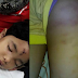 Kanak-Kanak Perempuan Terpaksa Menerima Belasan Jahitan