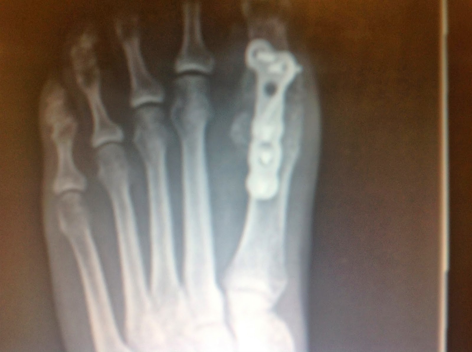 Foot and Ankle Problems By Dr. Richard Blake Wednesday's Article of the Week Gait Changes Post