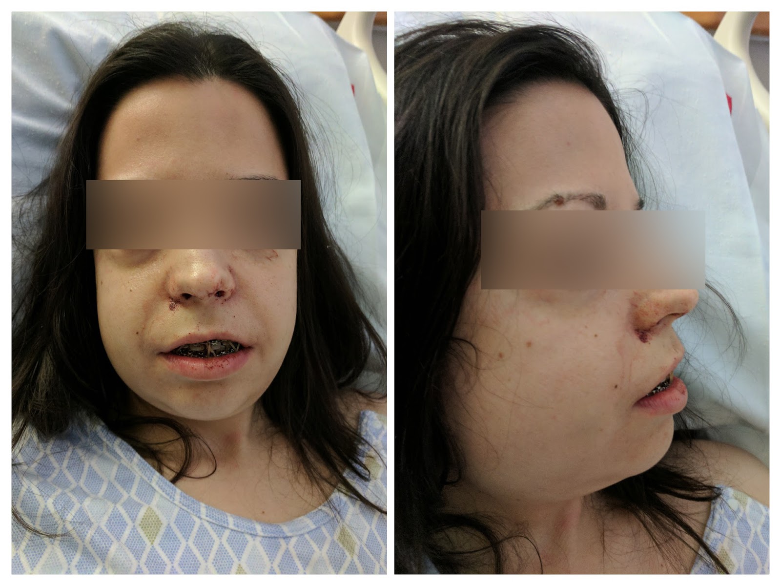Jaw Surgery Recovery Timeline
