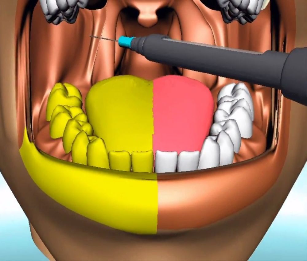 Anestesia Dental