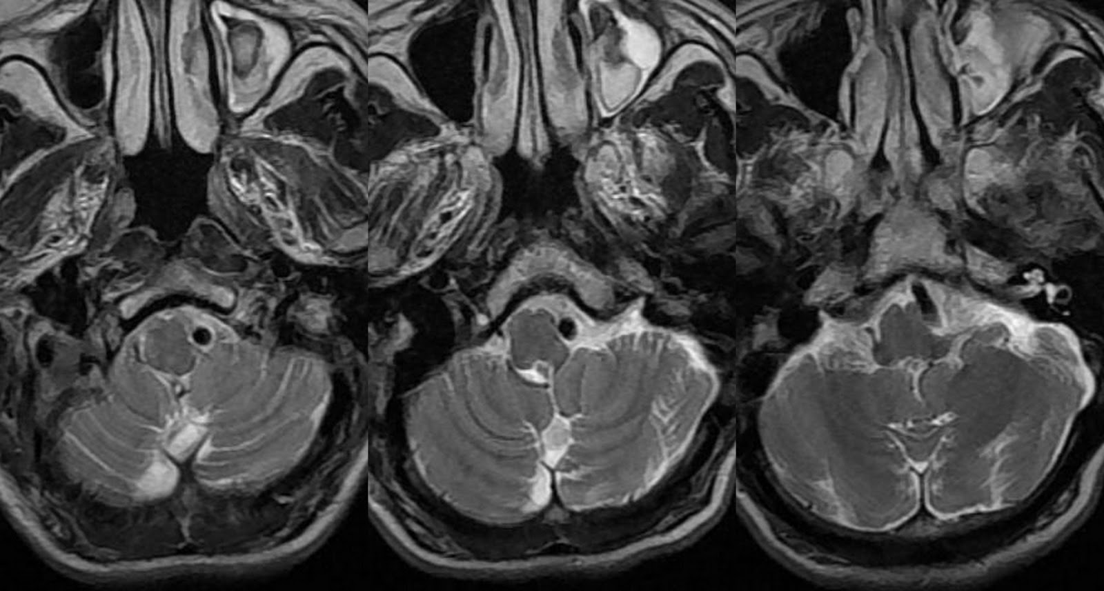 Dr Balaji Anvekar FRCR Vertebral Artery Compressing Medulla Dr Balaji Anvekar FRCR Vertebral Artery Compressing Medulla
