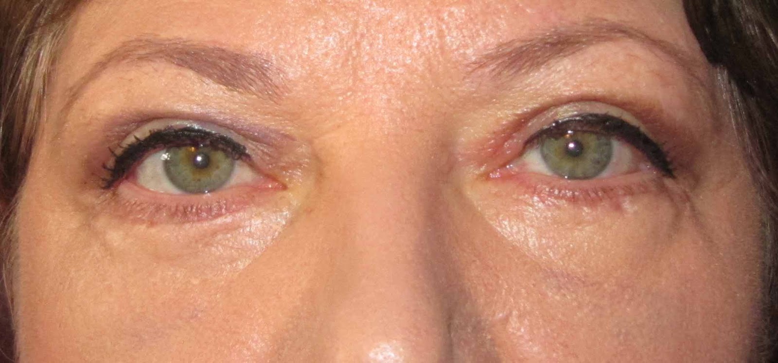 My account of puffyeye surgery (blepharaplasty) Camouflaged for Sunday 11th Day