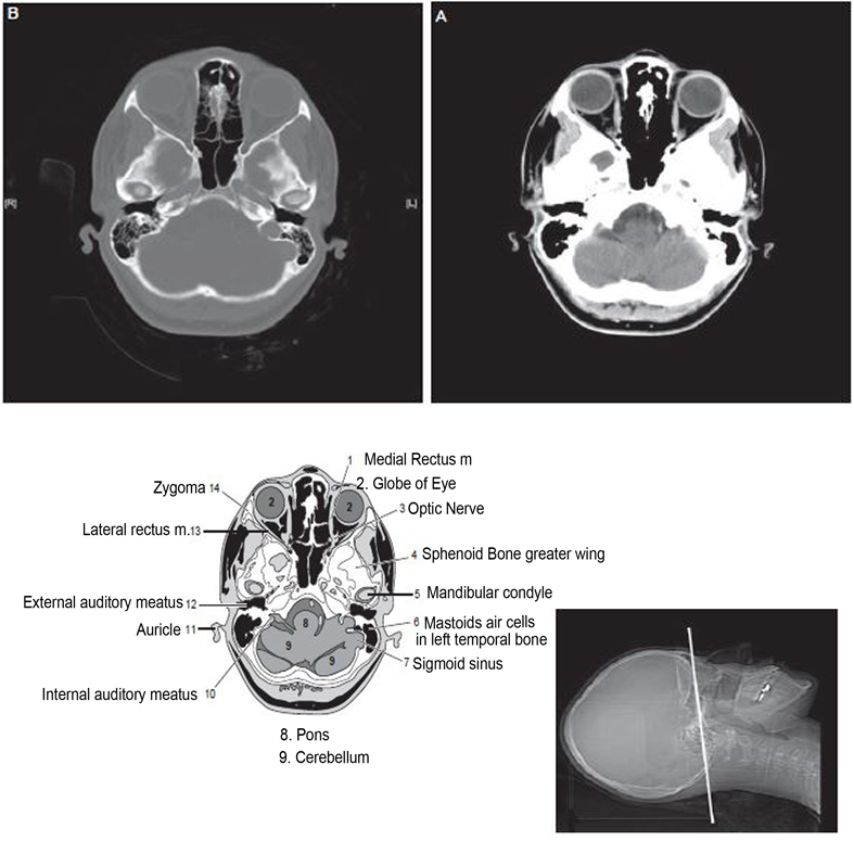 Ct Scan Head Anatomy