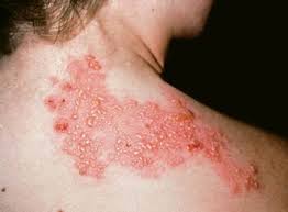 Image BAGAIMANA CARA MEMBUAT OBAT PENYAKIT HERPES DENGAN DAUN PILIHAN