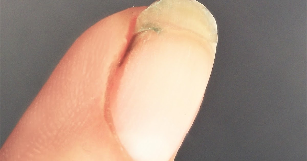 Abnorm Nail Behavior Nail Art How To Repair A Splitting Nail Super