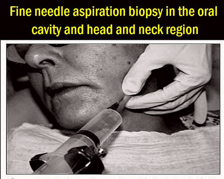 PDF Fine needle aspiration biopsy in the oral cavity and head and neck