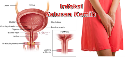 Obat Alami Untuk Menghentikan Nanah Di Kemaluan Wanita