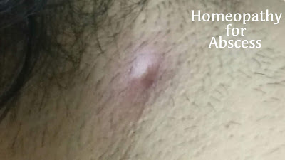 Homeopathy for Abscess