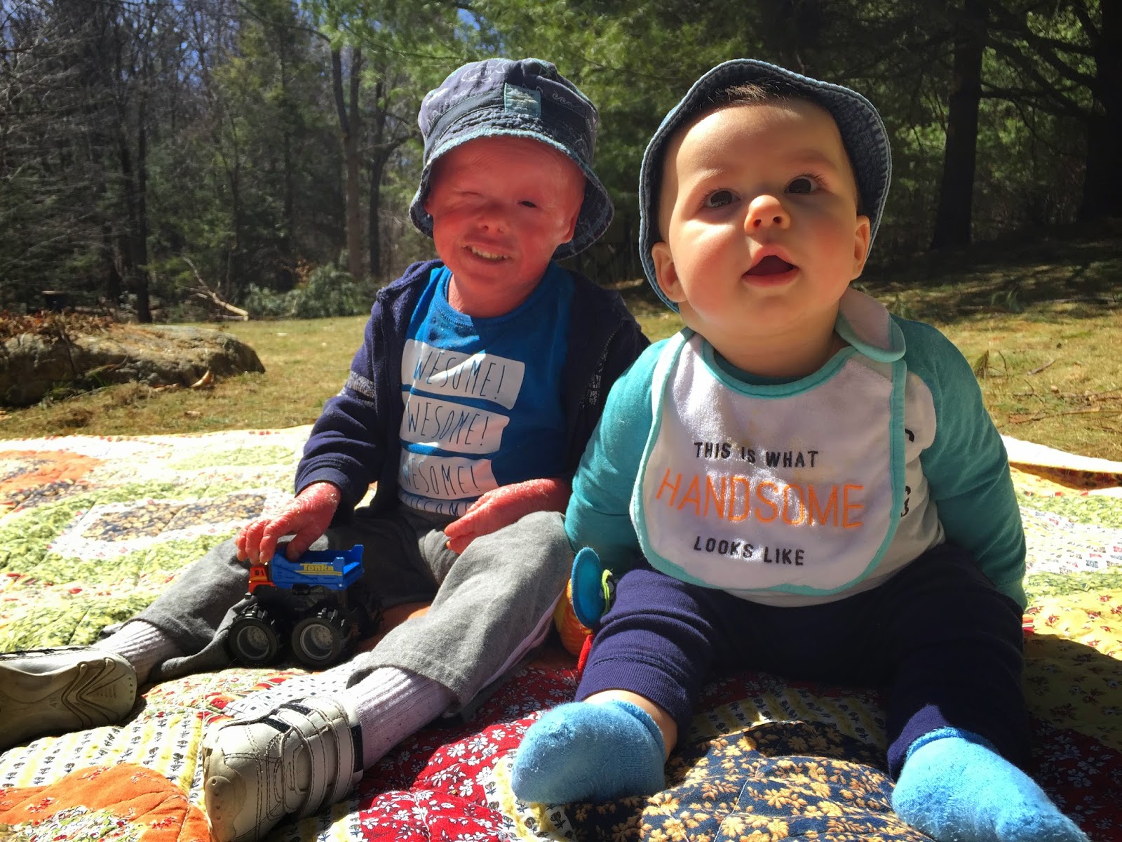 Evan, who has Harlequin Ichthyosis, with his brother