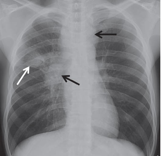 Study Medical Photos A 25 Year Old Man Presents With Cough, Low grade