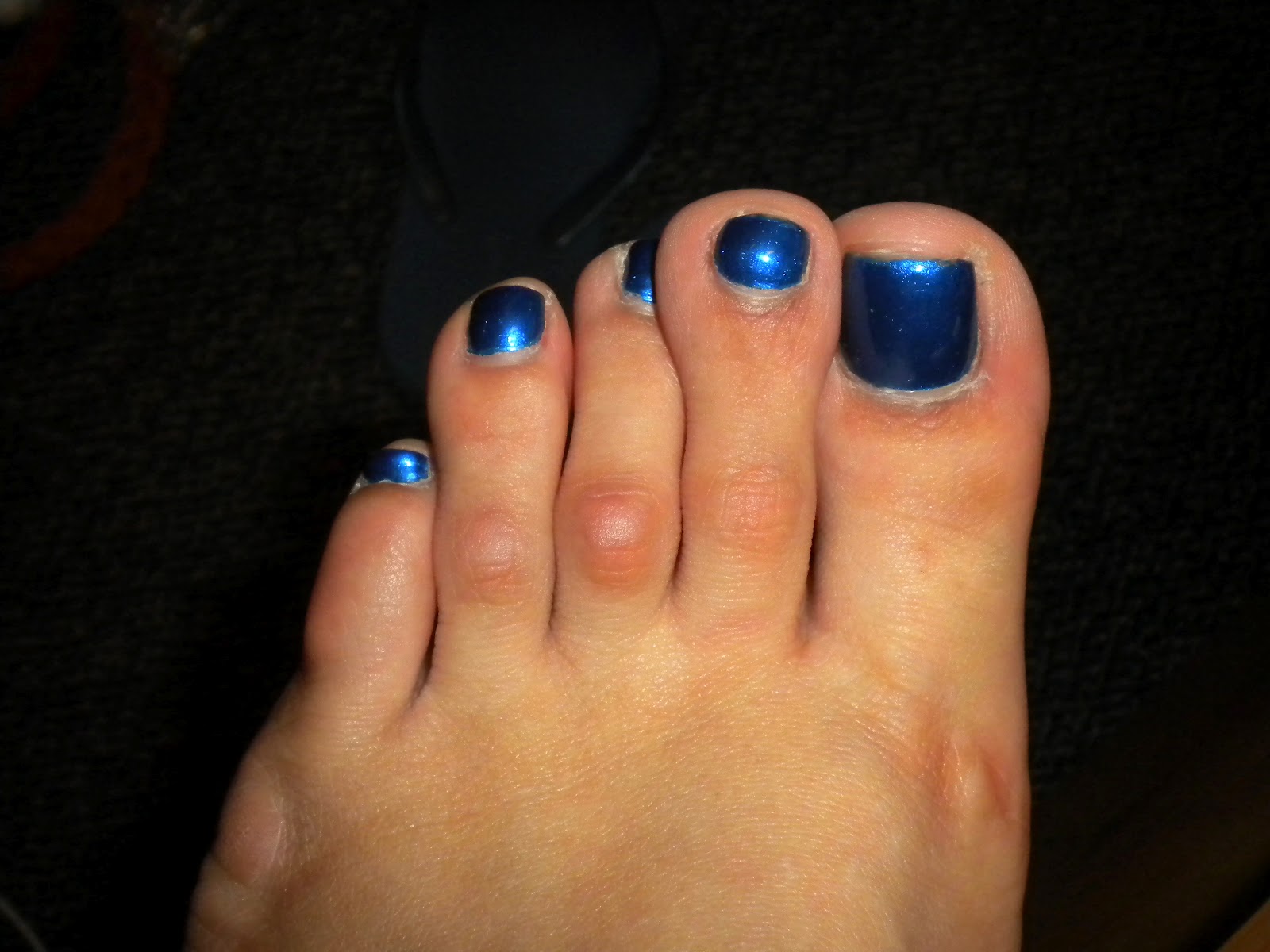 Recovery for Hammer Toe/Toe Shortening Surgery Before And After Pics