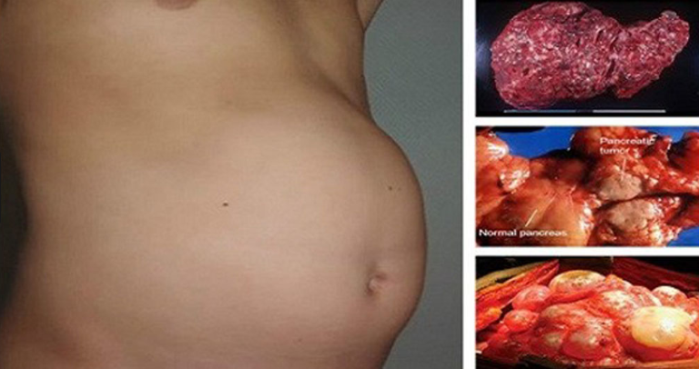 Your Stomach Is Still Bloated? Never Ignore This Warning Sign