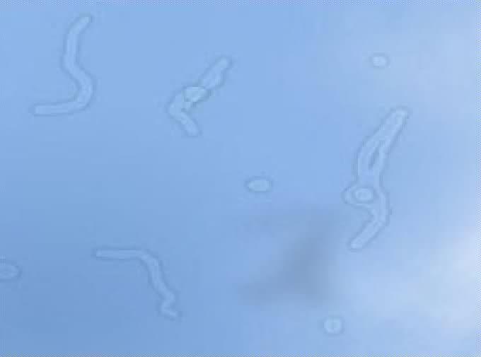 Eye Floaters Information In