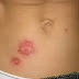 Treatment of fungal infections- The fungal infection reason ( in easy ) .