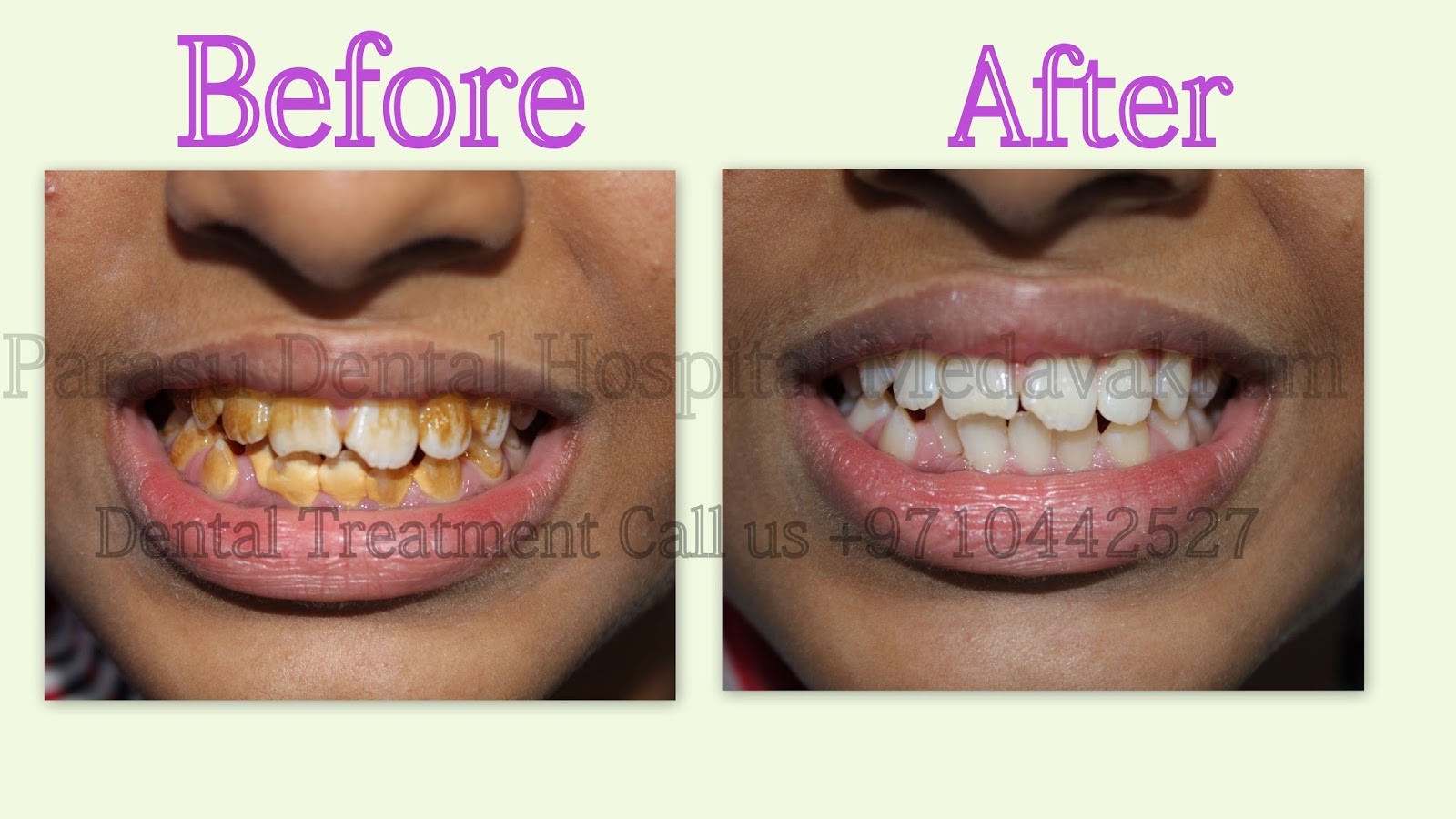 Dental Xray center in medavakkam Teeth cleaning in chennai