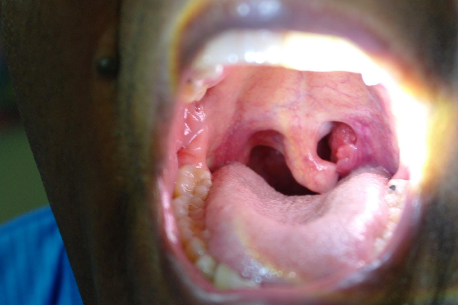 MyTonsil-Cancer: How the journey started