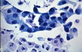 que significa metaplasia escamosa madura endocervical que significa metaplasia escamosa madura endocervical