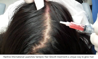 Hairline International Launches Vampire Hair Growth treatment a unique way to grow hair