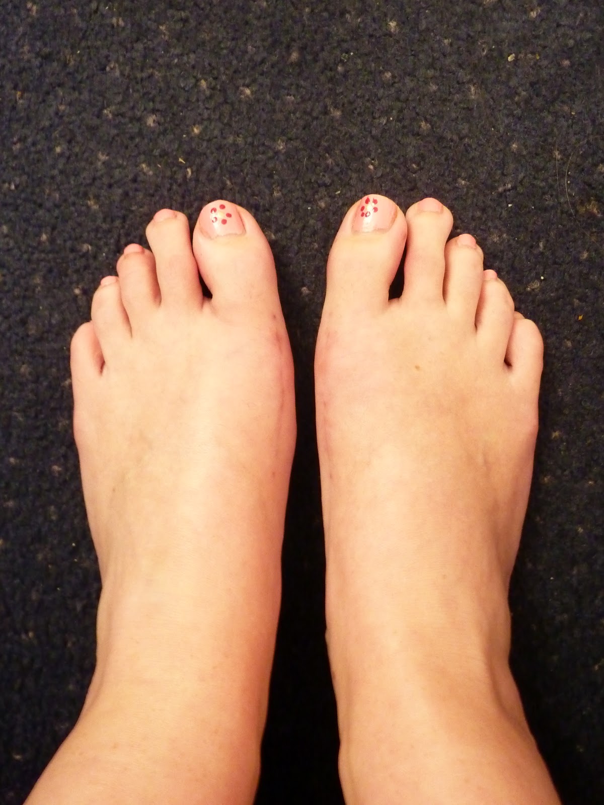 From bunions to beautiful feet Wobbles and worries