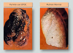 Cuestionario COPD-PS. ¿Quieres descubrir si tienes una enfermedad pulmonar?. Pincha en la imagen.