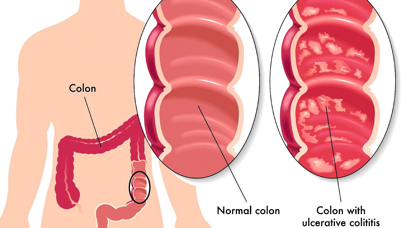 Ulcerative Colitis And Eye Problems Ulcer Choices