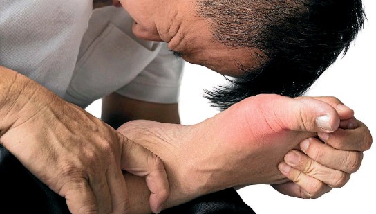 أعراض النقرس وكيفية الوقاية منه وعلاجة