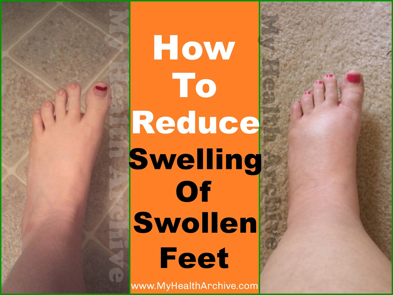 Swelling Of Foot 110