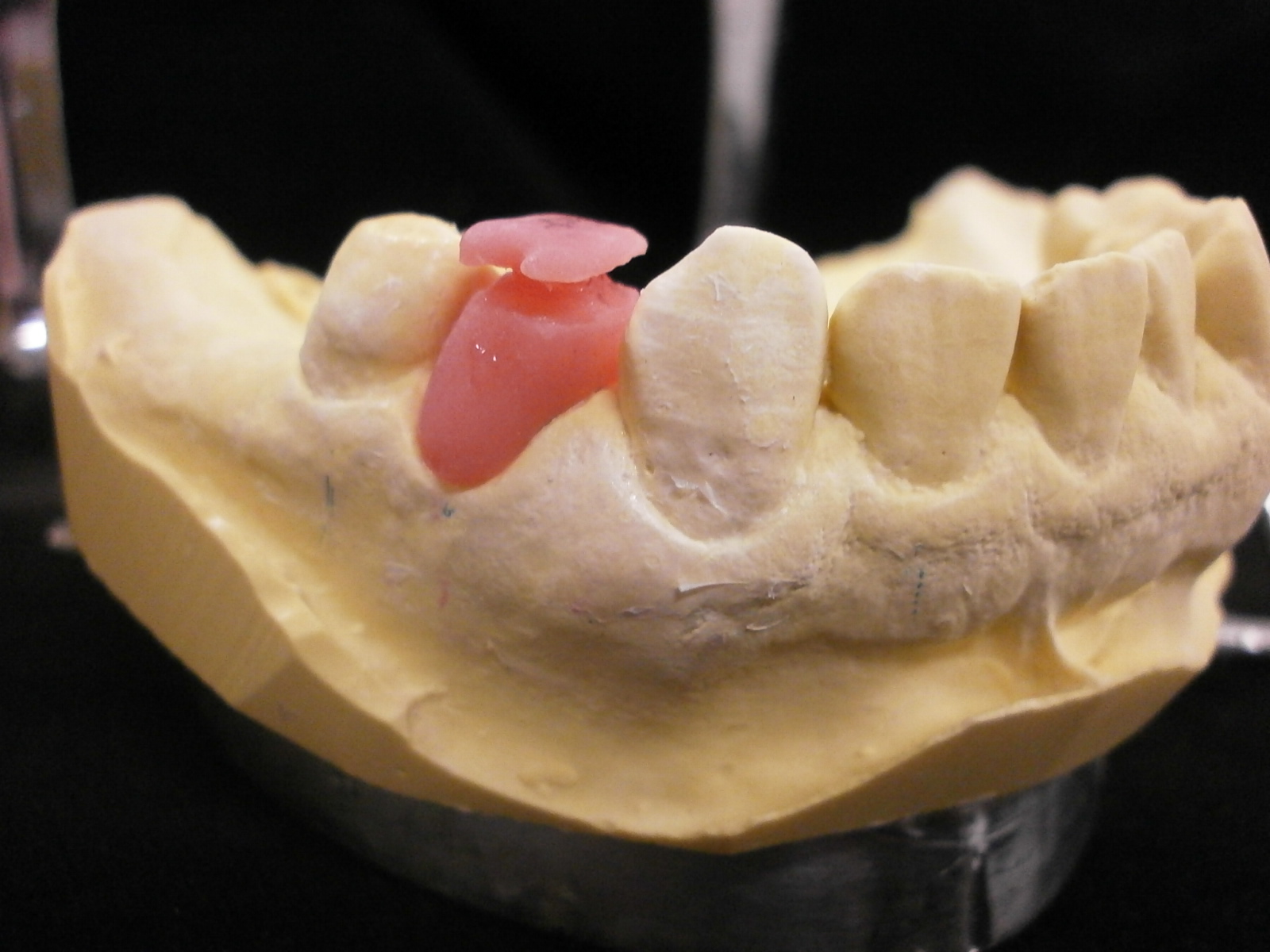 髙田朝（Hajime Takada）のオーダーメイド歯科技工物の紹介 Introduction of custommade dental