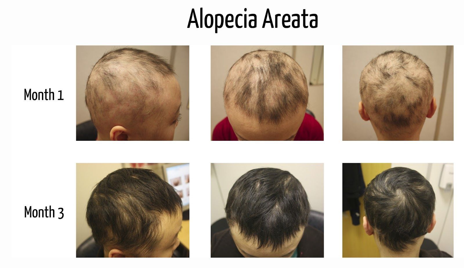 como evitar la alopecia areata en mujeres