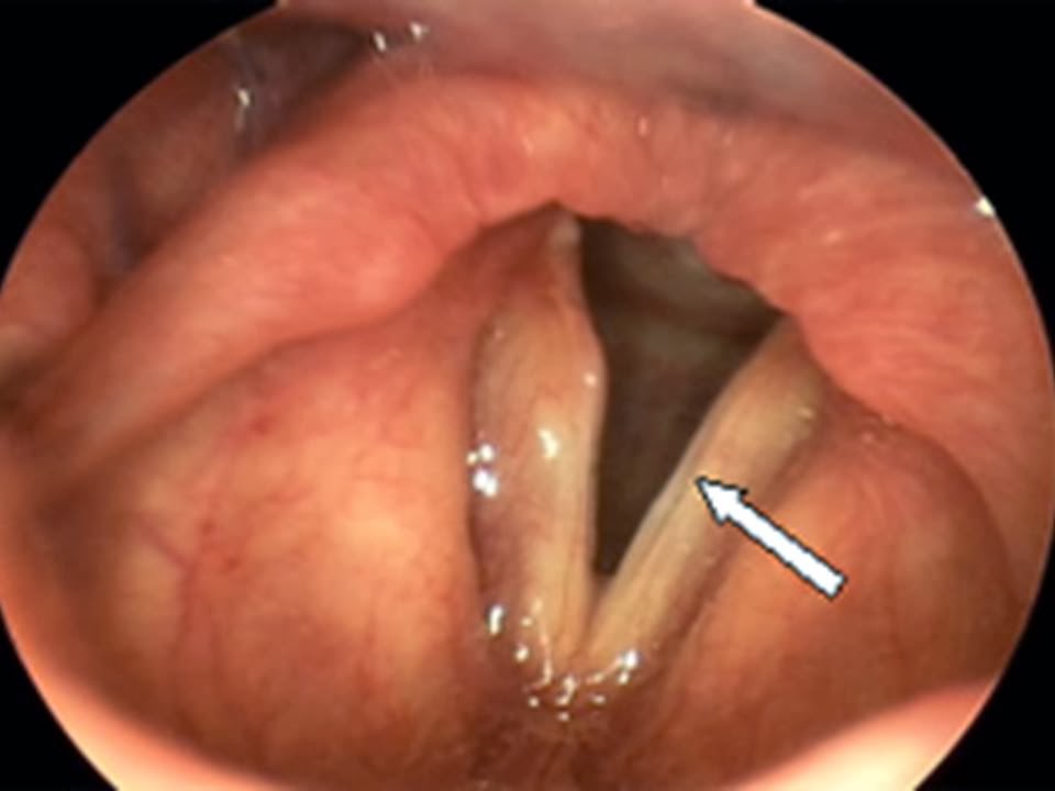 Edema cuerdas vocales operacion