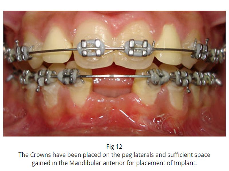ORTHODONTICS Management of Peg shaped lateral incisors and missing