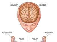 Pengobatan Alami Stroke Iskemik