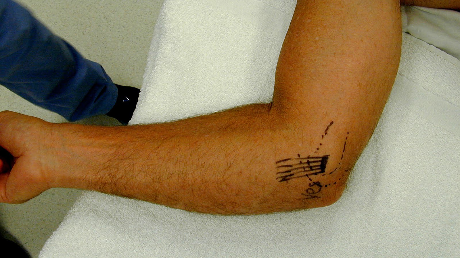 Ulnar collateral ligament injury of the elbow - Injury Choices