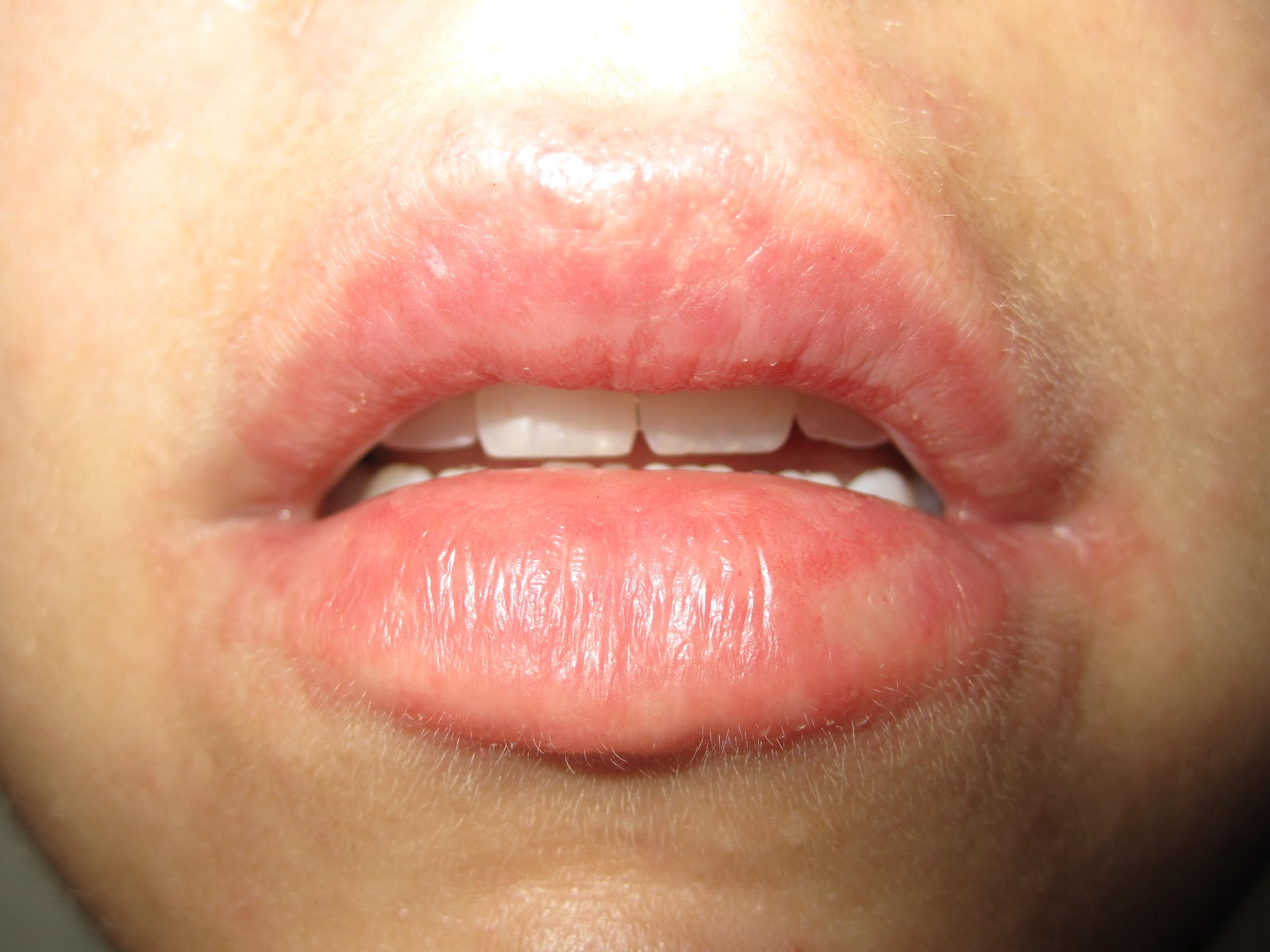 allergic reaction lips