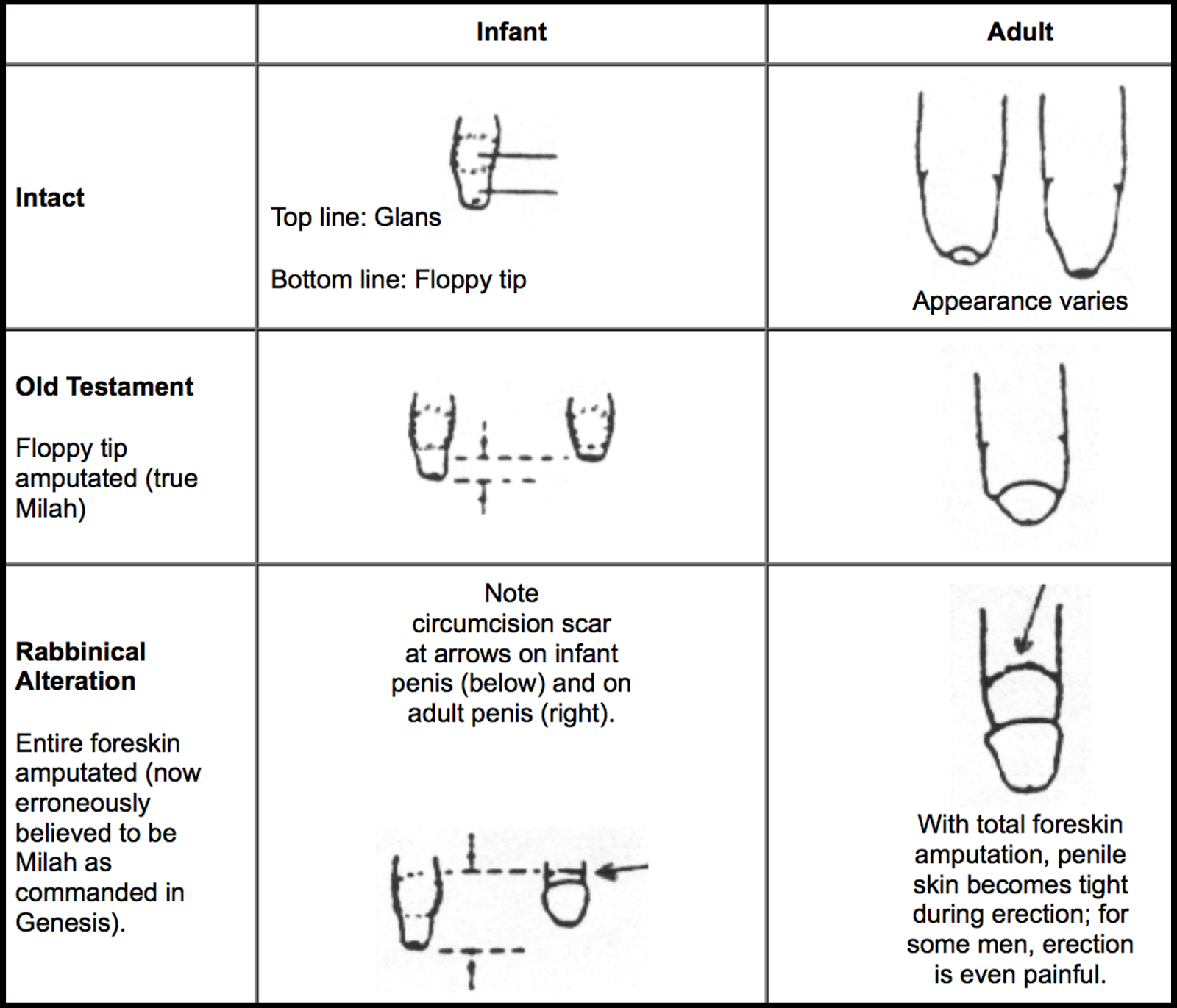 Male Circumcision Diagram Stages