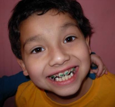 Niềng răng cho trẻ em có lợi ích gì?
