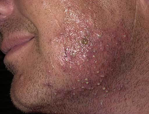 What Is a Staph Infection? Symptoms, Pictures