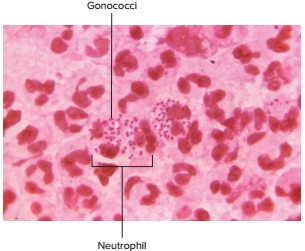 Neisseria Gonorrhoeae Bakteri Penyebab Penyakit Gonorrhea Referensi Biologi